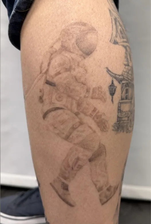 Tattoo po treh tretmajih laserskega odstranjevanja