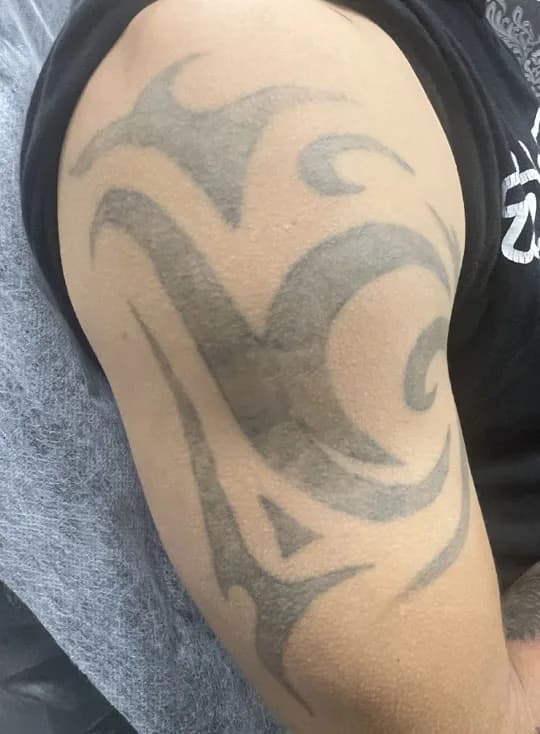 Večji tattoo po petih tretmajih laserskega odstranjevanja